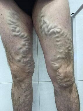 無視された男性の静脈瘤