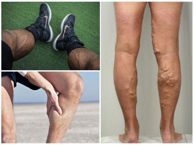 男性の足の静脈瘤はどのように見えるか