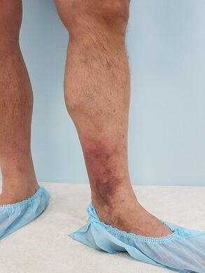男性の静脈瘤による合併症