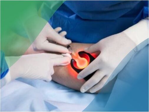 硬化療法は、下肢の静脈瘤を治療するための低侵襲技術です。