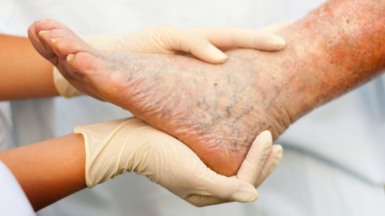 血管内科医は、脚の静脈瘤の治療を扱います
