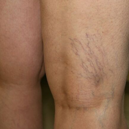 下肢の静脈メッシュは静脈瘤の兆候です