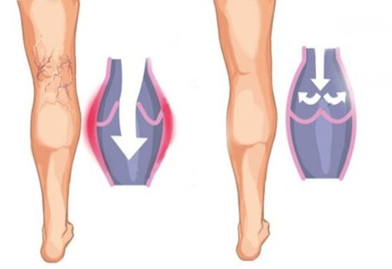 静脈瘤はどのように見えるか